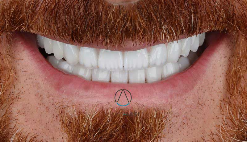 دندانپزشکی یکروزه در قم ( ایمپلنت فوری یک روزه قم )